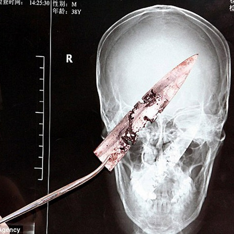 Chinese Man Lives With Knife In Head For 4 Years Amusing